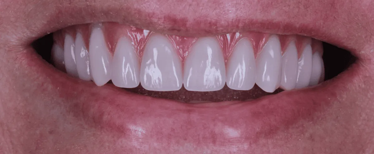Depois: sorriso reabilitado