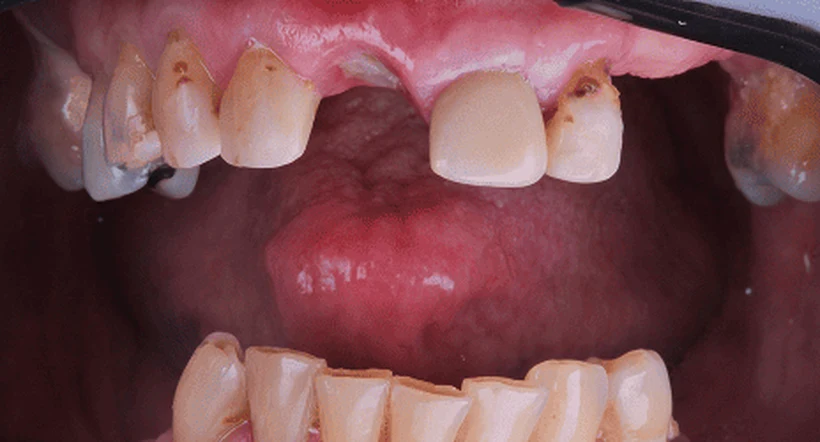 Antes: dentes ausentes e desgastados